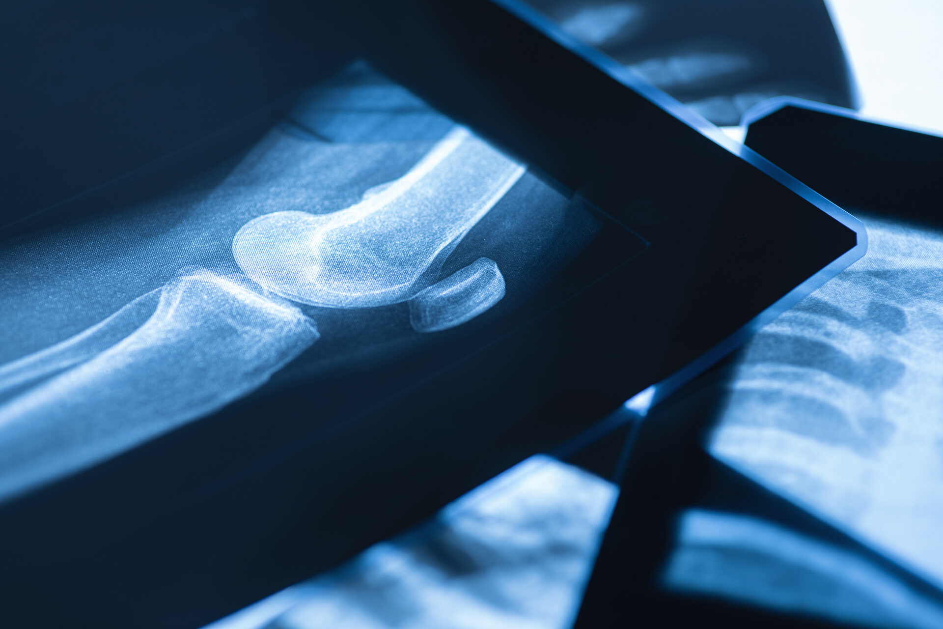 Lateral knee X-ray — orthopedic specialty diagnostics