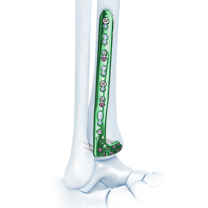 va distal lateral tibia locking plate