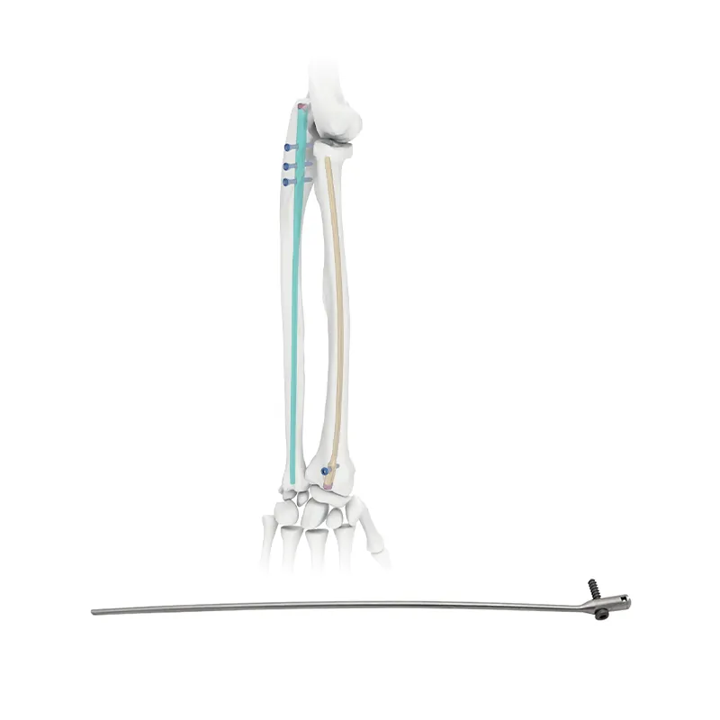 radius intramedullary nail
