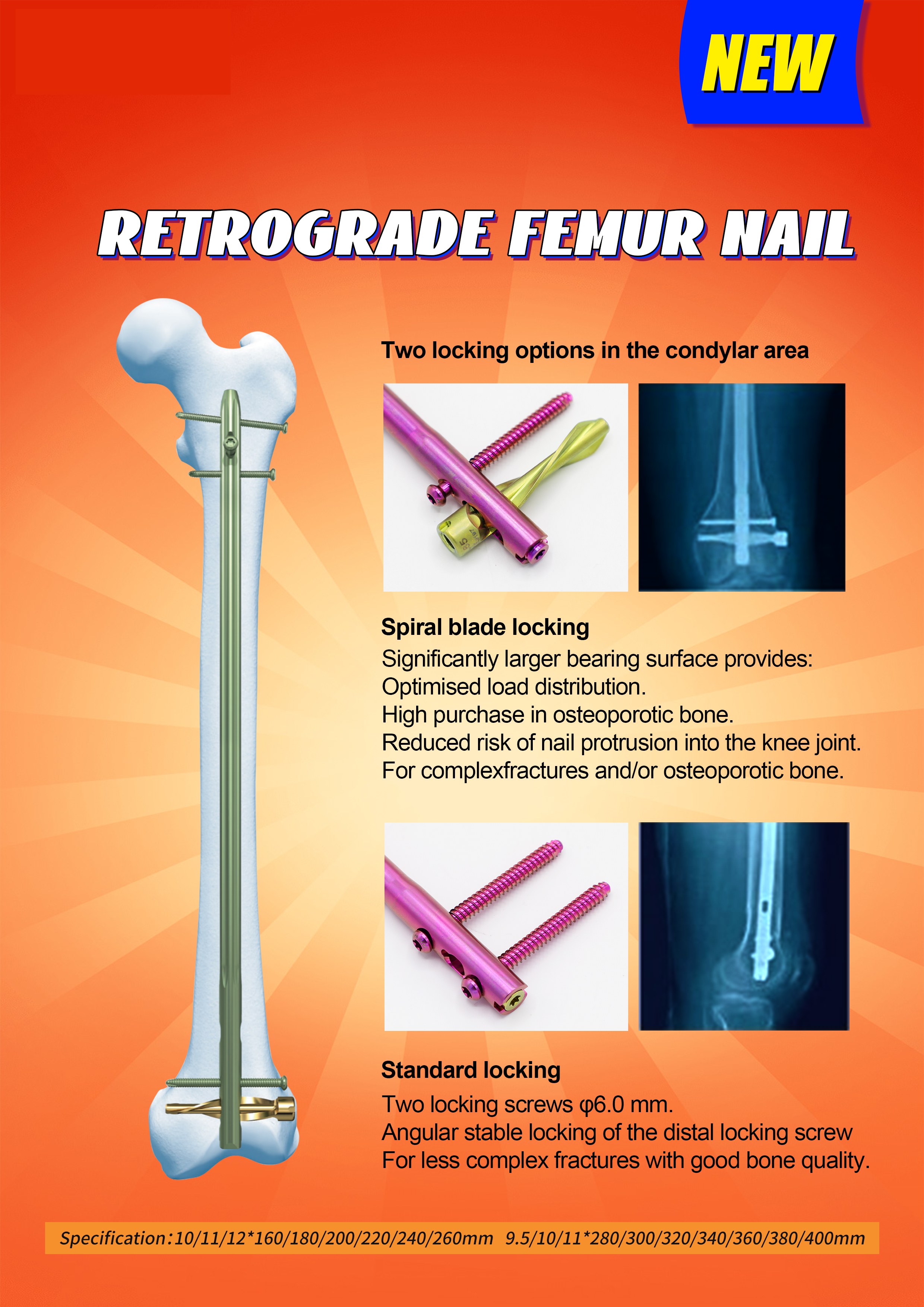 dfn distal femur intramedullary nail