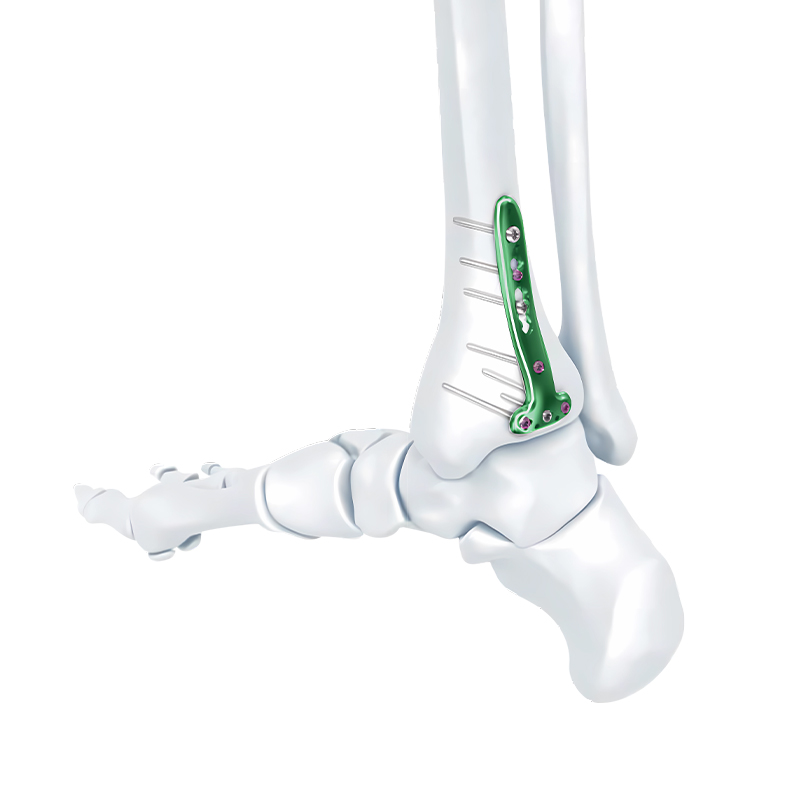 va distal tibia locking t plate