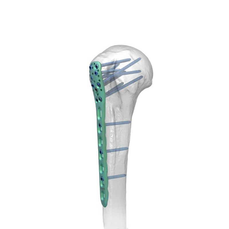 proximal humeral locking plate