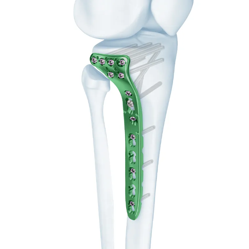va proximal tibia locking plate