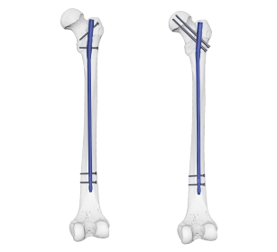 expert femoral nail