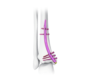 distal tibial intramedullary nail dtn