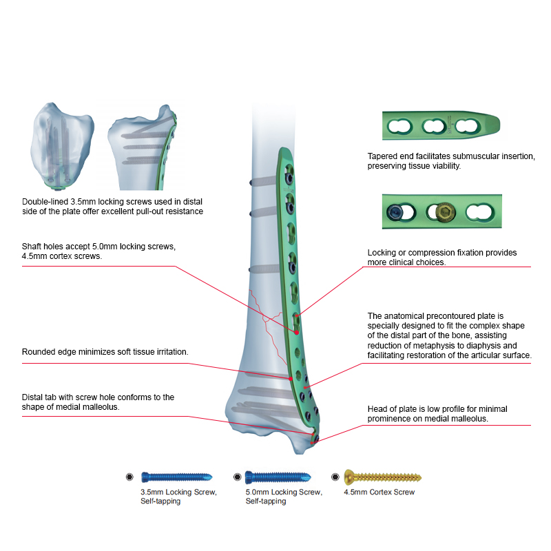 proximal lateral tibial locking plate i