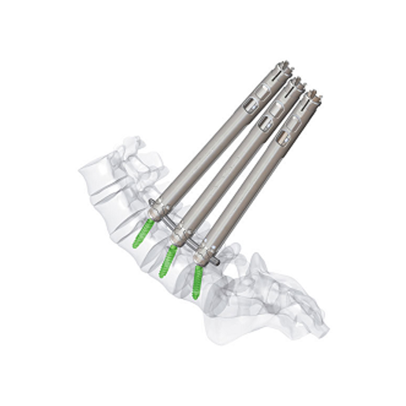 5 5 minimally invasive pedical screw