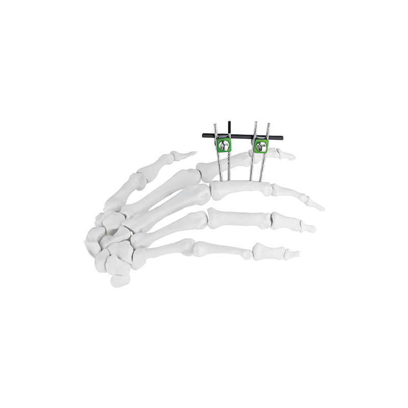 finger palm external fixator
