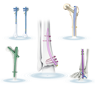 expert reversed femoral intertan intramedullary nail box