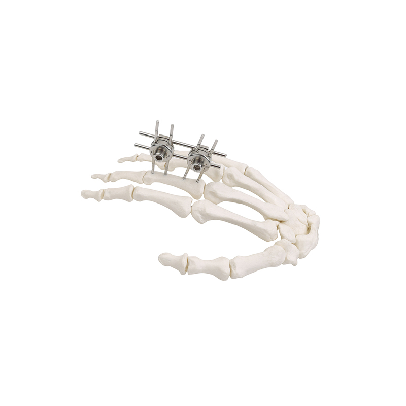 mini external fixator finger palm 557155348