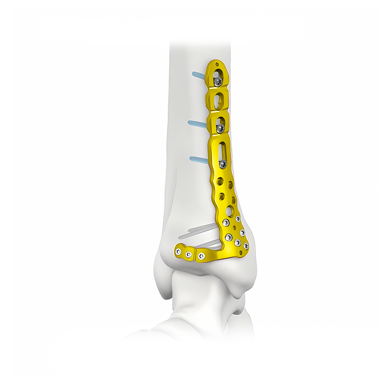 proximal lateral tibial locking plate i