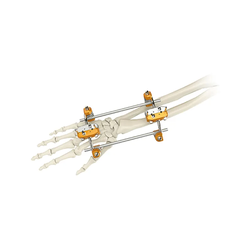 uina radius external fixator