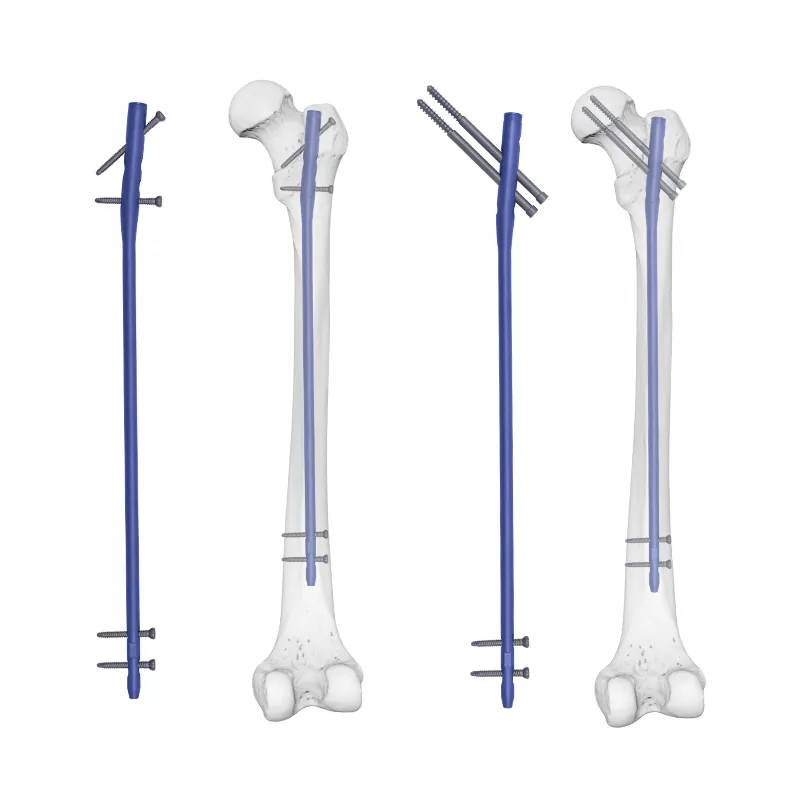 expert femoral nail