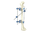 3d type external fixator