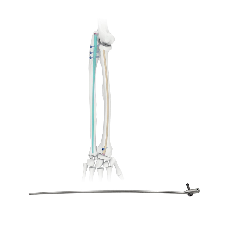 radius intramedullary nail