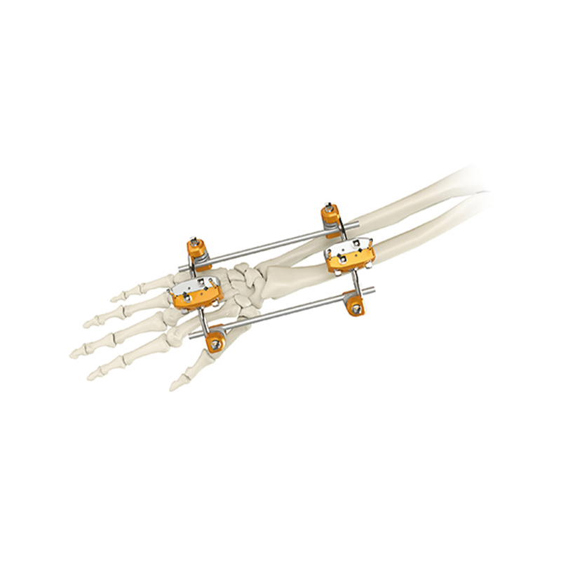 uina radius external fixator