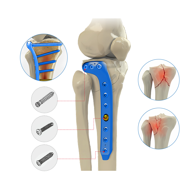 proximal lateral tibial locking plate i