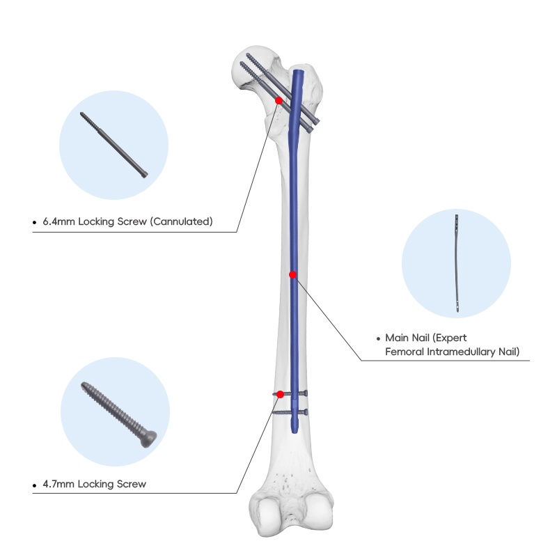 expert femoral intramedullary nail box
