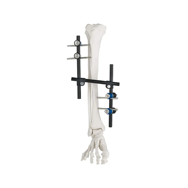 z type external fixator