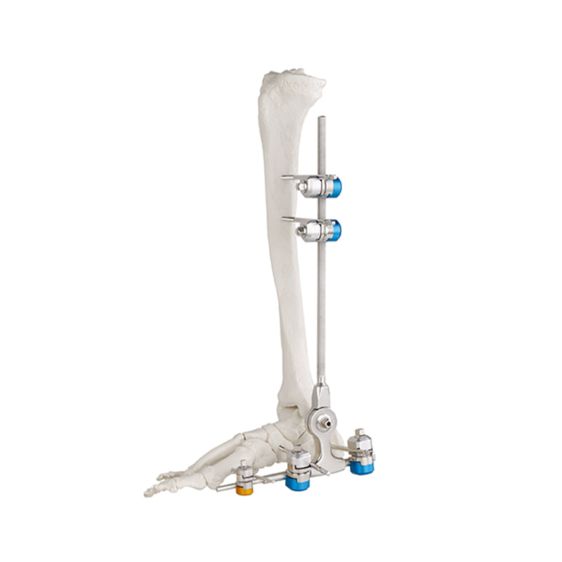 ankle fusion joint external fixator