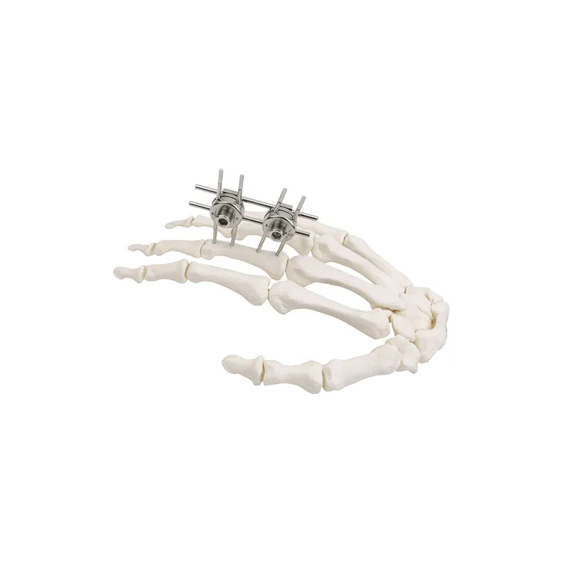 mini external fixator finger palm 557155348