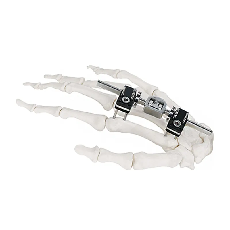 mini fragment external fixator type a