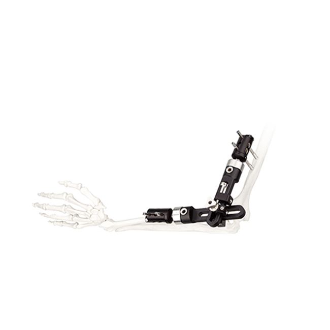 elbow fragment external fixator