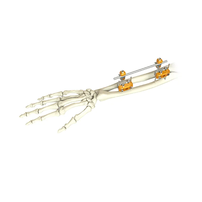 forearm external fixator