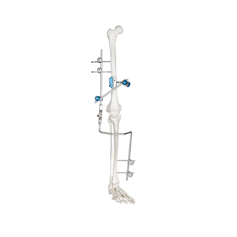 knee joint external fixator 41699450