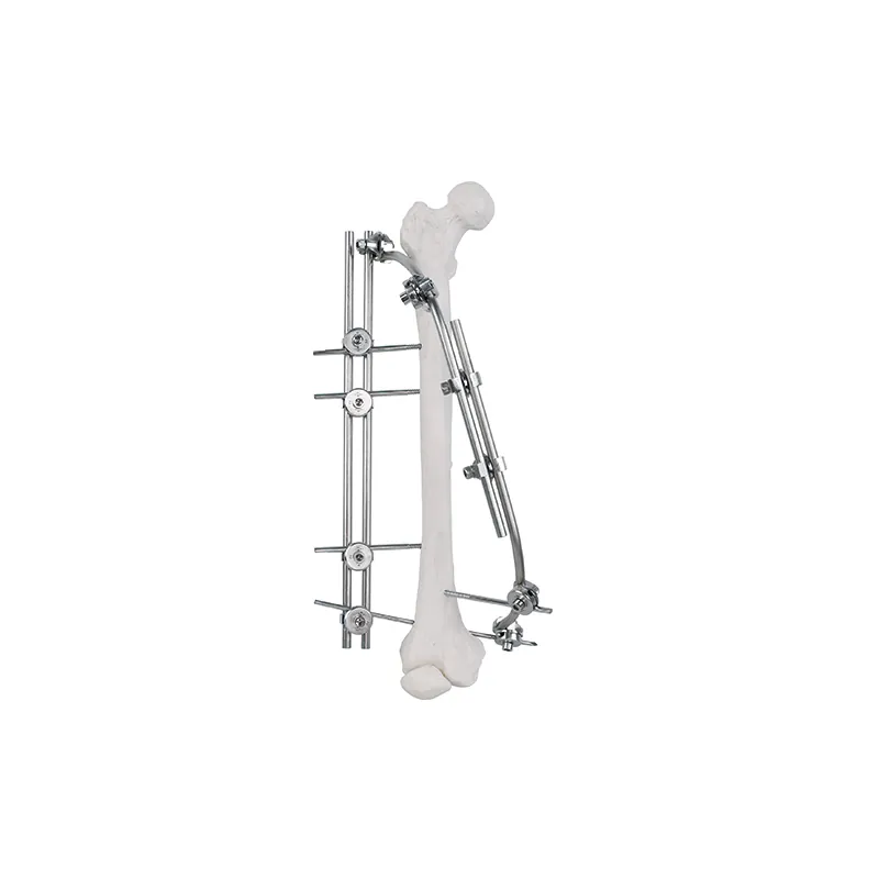 femoral shaft external fixator 9100 2301