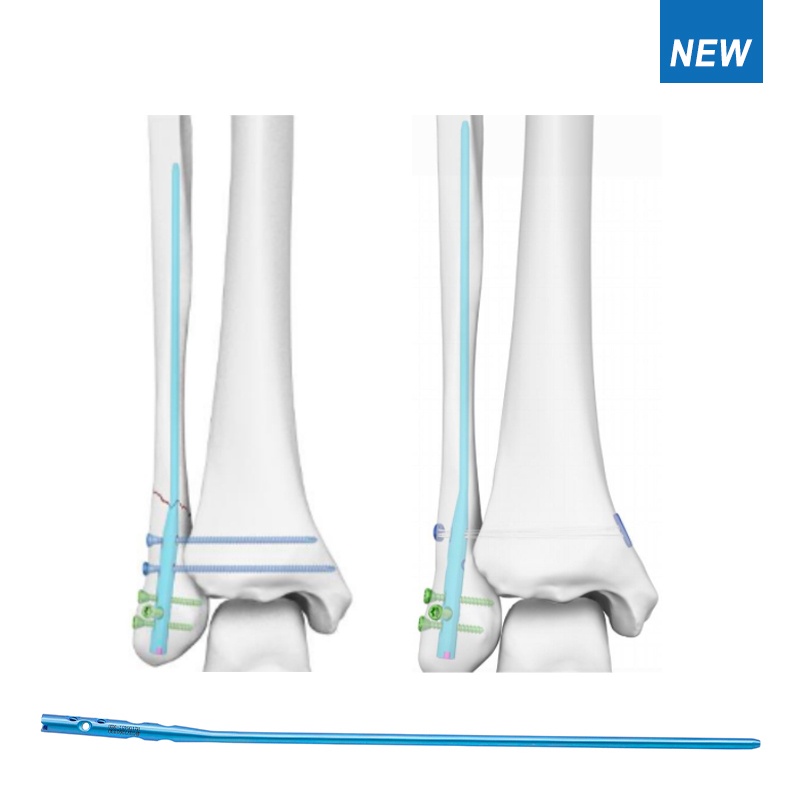 expert fibular intramedullary nail