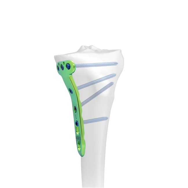 proximal medial tibial osteotomy locking plate