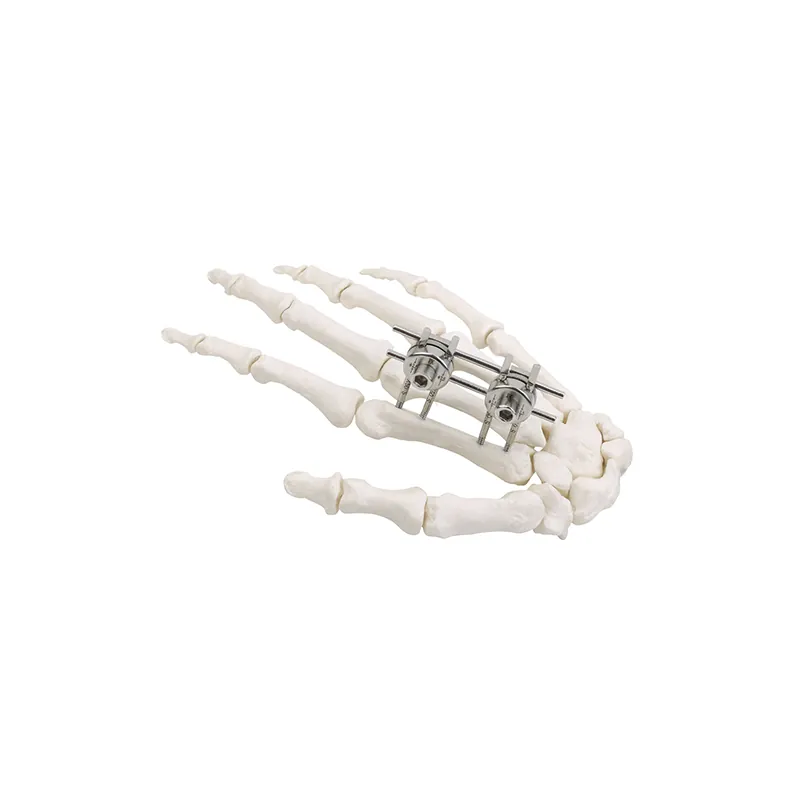 mini external fixator finger palm 547155348