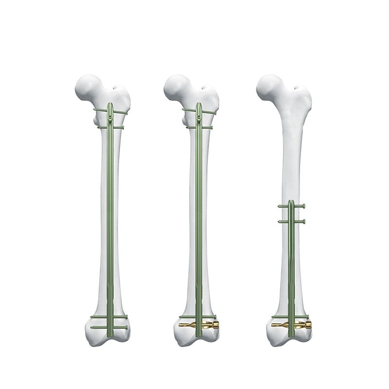 dfn distal femur intramedullary nail