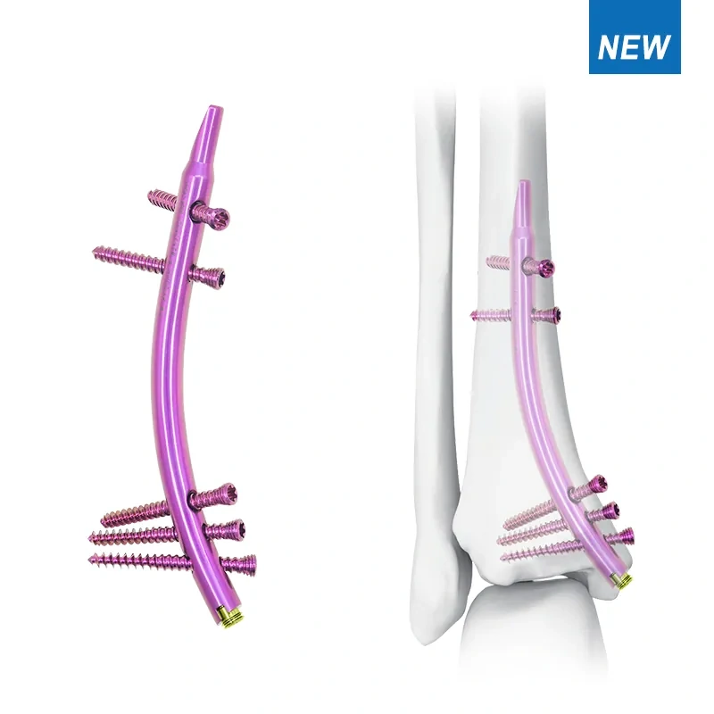 distal tibial intramedullary nail dtn