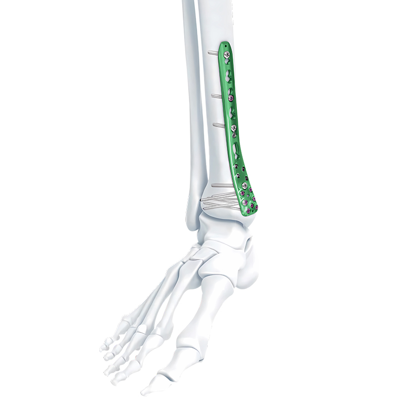 va distal medial tibia locking plate