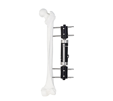 dynamic axial straight type external fixator