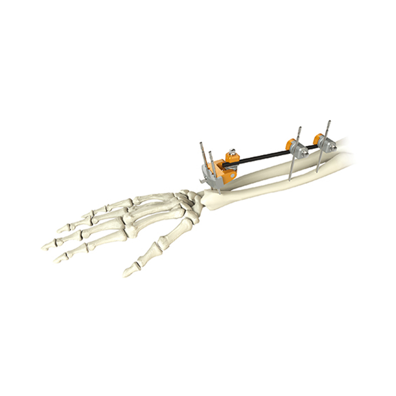 distal radius external fixator