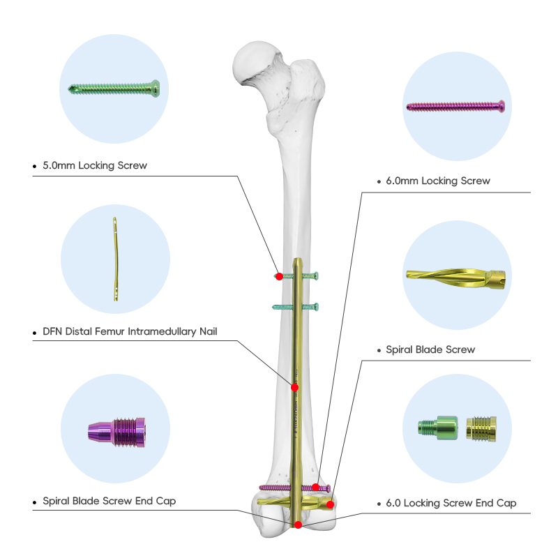 dfn distal femur intramedullary nail instrument set spiral blade screw type 1200 21