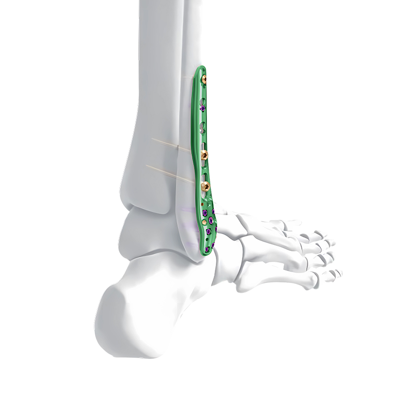 distal lateral fibular locking plate