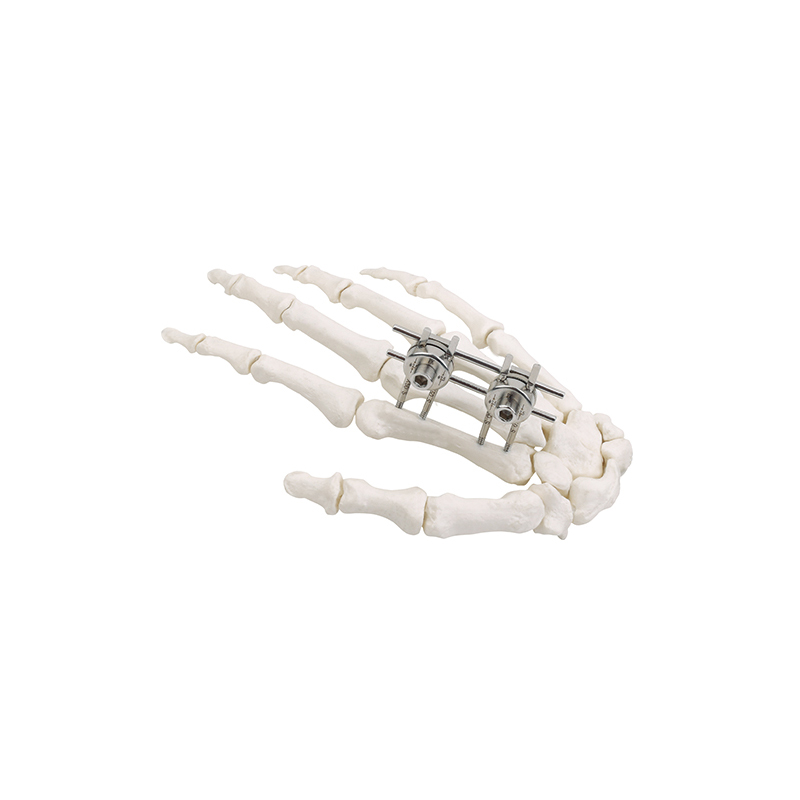 mini external fixator finger palm 547155348