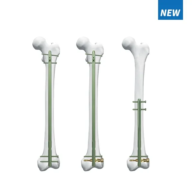 dfn distal femur intramedullary nail