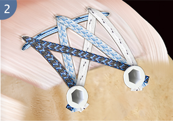 polyethylene suture ethicon suture