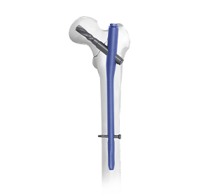 pfna nail