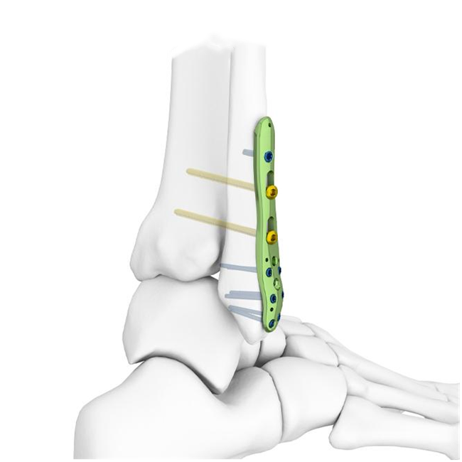 distal fibular locking plate
