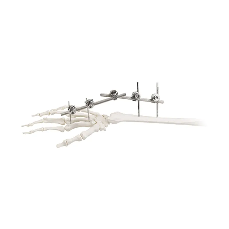 wrist joint external fixator 9100 1501