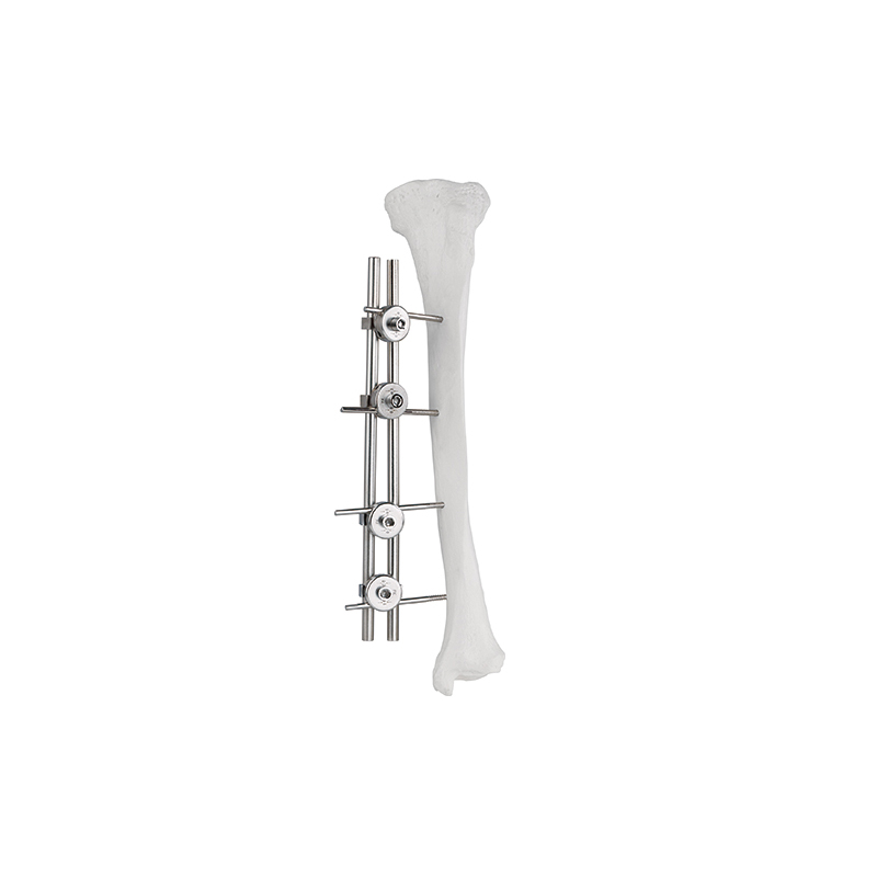 double rod single side external fixator