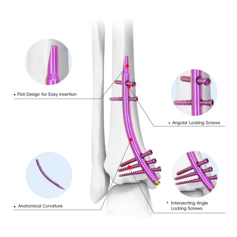 distal tibial intramedullary nail dtn box 1000 0139