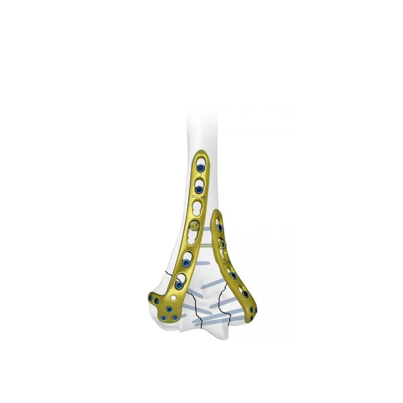 distal lateral humeral locking plate