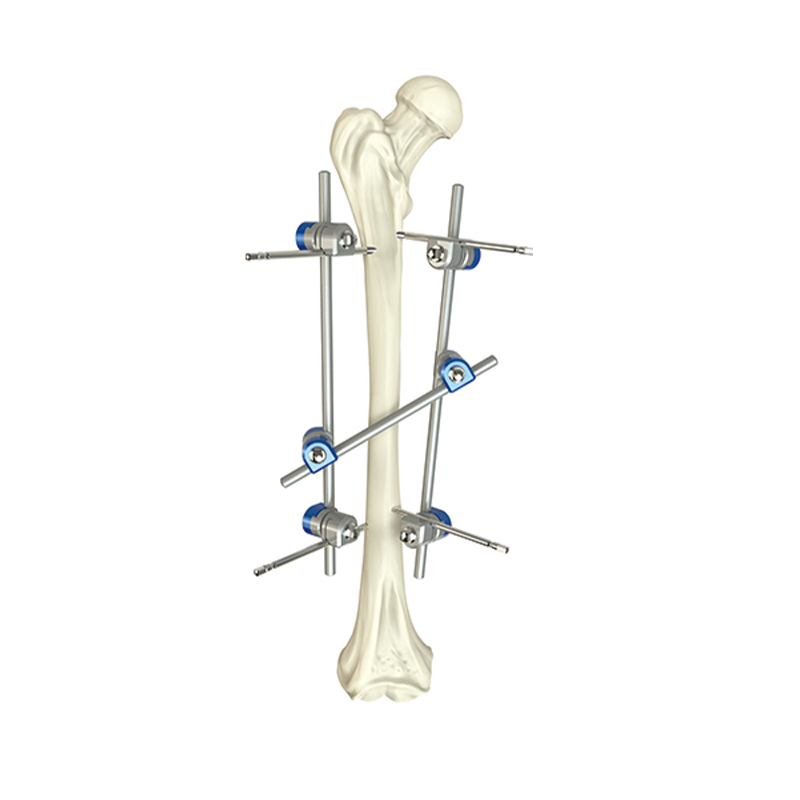 femoral shaft external fixator